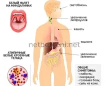 Вірусна інфекція Епштейна Барра симптоми у дорослих та дітей вірусна