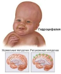 мозъка дропсия