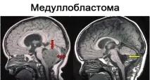 Пухлини центральної нервової системи (ЦНС) у дітей - симптоми та лікування дітей