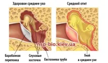Гострий отит – застосування БАД НСП для лікування дітей отит