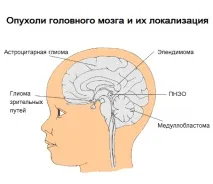 Пухлини центральної нервової системи (ЦНС) у дітей - симптоми та лікування нервової
