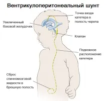 Пухлини центральної нервової системи (ЦНС) у дітей - симптоми та лікування пухлини