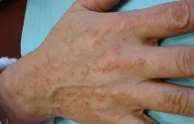 Передозування кагоцелом у дітей та дорослих кагоцелом