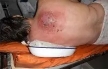 Передозування метронідазолом, симптоми отруєння та подальше лікування симптоми