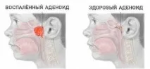 горлі