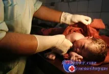 Показання до кесаревого розтину при гестозі гестозі