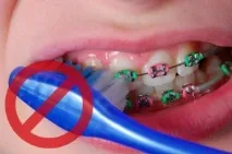 Скільки коштують брекети на зуби Є відповідь! скільки
