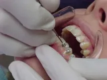 Скільки коштують брекети на зуби Є відповідь! зуби
