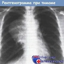 определение тимома