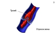причини