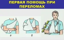 фрактури първа