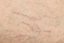 паякообразни мрежести