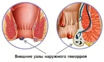 геморой