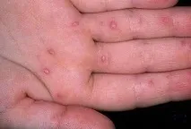 морбили ръцете