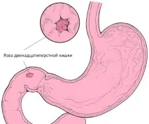 Запалення дванадцятипалої кишки симптоми та лікування симптоми