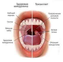 симптоми тонзилит