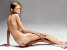 жени анорексични
