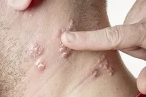 кожата алергичен