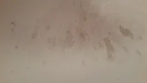лечението жужещия