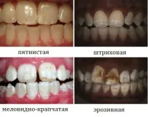 Флюороз - профілактика та причини захворювання причини