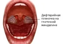 Гнійні та казеозні пробки у горлі гнійні