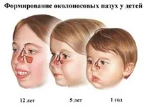 синузит симптоми