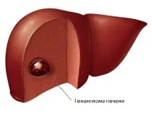 Гемангіома печінки причини, симптоми та лікування причини