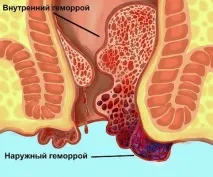 Геморой - види, ознаки, поради проктологів поради