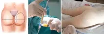 Як підтягнути сідниці та стегна - методи корекції корекції