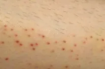 подразнення