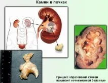 бъбреците премахнете