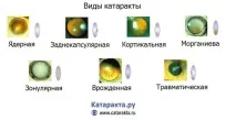 Класифікація катаракти (види та стадії) - з причин, гостроти зору, локалізації помутнінь у стадії