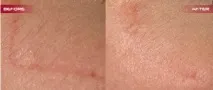 Корекція рубців у Ізраїлі ціна, відгуки, ціни ізраїлі