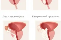 простатиту