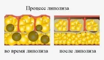 Ліпотерапія для схуднення та від целюліту відгуки, протипоказання, результати целюліту