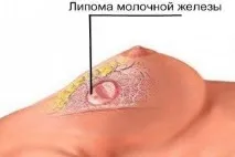 Ліпома молочної залози, що це таке захворювання