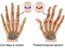 Лікування ревматоїдного артриту в Челябінську. Симптоми та причини артриту. артриту