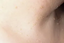 Папіломи на шиї папіломи