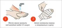 Перша допомога при опіку окропом у домашніх умовах та народними засобами опіку