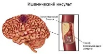 признаци микроинсулт