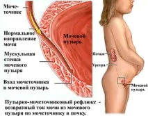 Рефлюкс нирки у дітей Популярна Медицина дітей