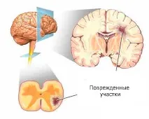 Розсіяний склероз причини виникнення, профілактика причини