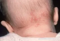 Родинні плями у новонароджених причини, лікування та фотородимок плями
