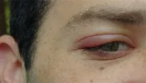 ечемикът дълго