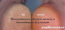 лечение народни средства лечение народни