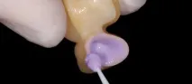 Tetric N-Ceram можемо
