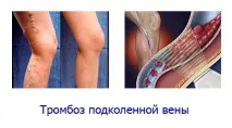 Тромбоз підколінної вени (артерії) - що це таке, причини, симптоми, лікування, фото, флотуючий, вени