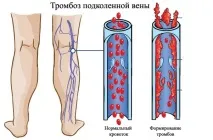 тромбоза