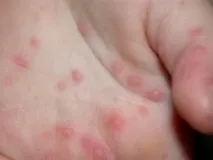 Вірус Коксакі у дітей симптоми та лікування коксакі