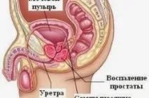 ефект простатита